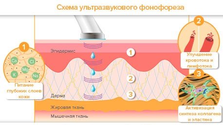 Фонофорез лица с гидрокортизоном, карипаином, гиалуроновой кислотой. Показания и противопоказания, аппараты для ультразвуковой процедуры