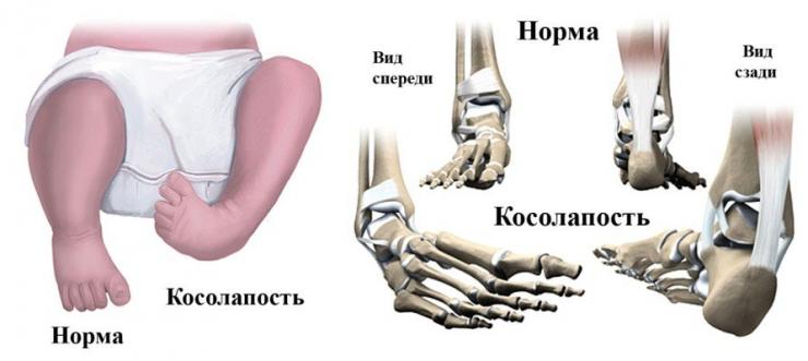 Лечение эквиноварусной деформации стоп