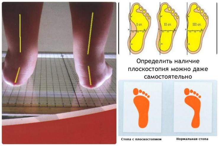 Лечение эквиноварусной деформации стоп