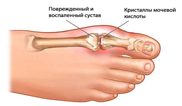 Лечение суставовКто лечит подагру из врачей