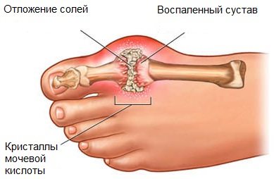 подагра на ногах лечение