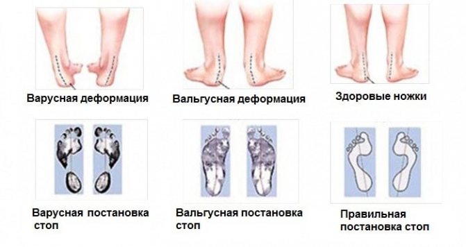 Примеры деформации стоп в сравнении с нормой.