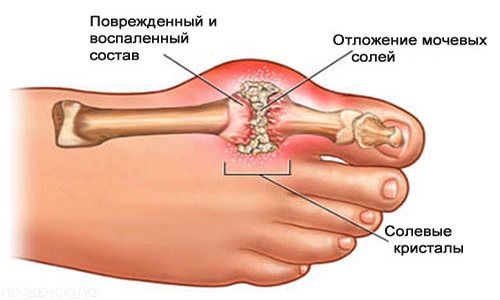 Проблема подагры