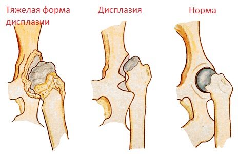 Упражнения при дисплазии тазобедренных суставов у детей